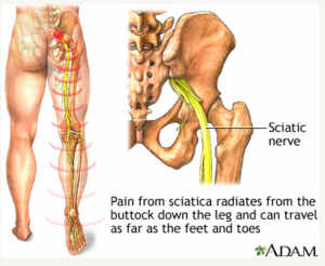 how long does sciatica last