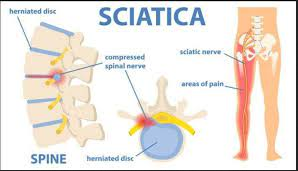 How large sciatica last