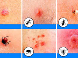 How to get rid of bug bite scars
